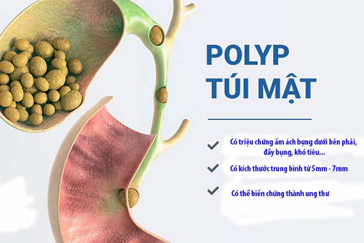 Polyp túi mật là một bệnh khá phổ biến, có thể xuất hiện ở mọi lứa tuổi nhưng chủ yếu gặp ở người trưởng thành.